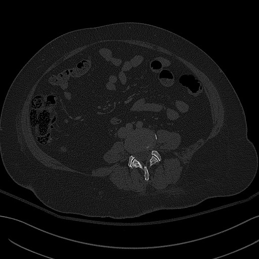 File:Breast carcinoma with pathological hip fracture (Radiopaedia 60314-67993 Axial bone window 3).jpg