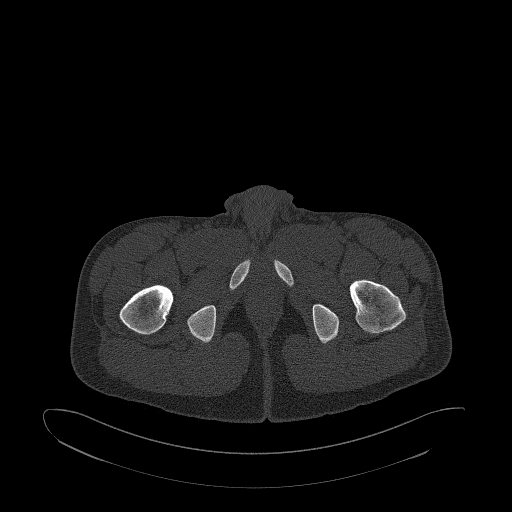 Brodie abscess- femoral neck (Radiopaedia 53862-59966 Axial bone window 202).jpg