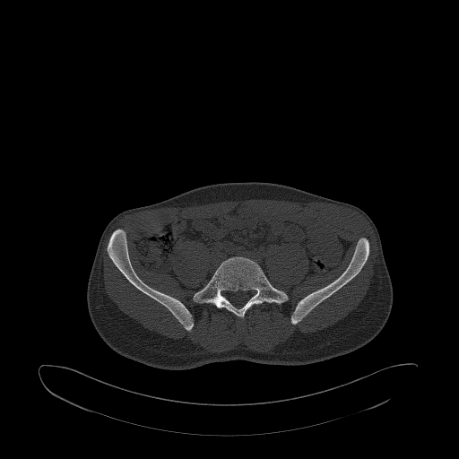 Brodie abscess- femoral neck (Radiopaedia 53862-59966 Axial bone window 4).jpg