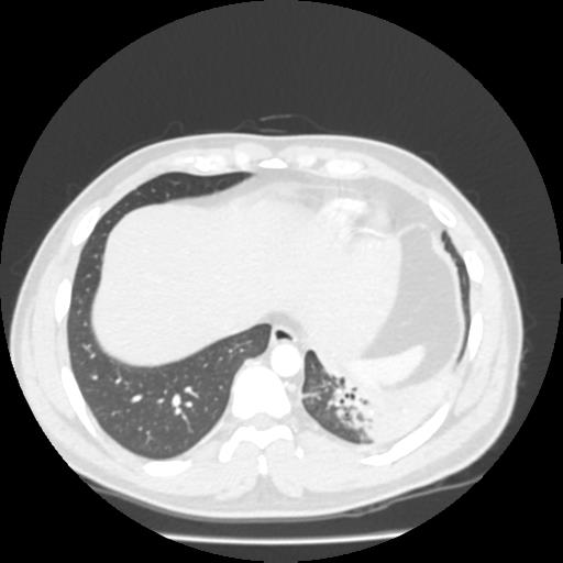 Bronchial carcinoid (Radiopaedia 80013-93291 Axial lung window 103).jpg