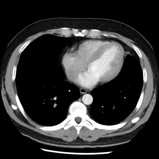 Bronchial carcinoid tumor (Radiopaedia 67377-76764 A 42).jpg