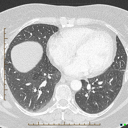 Bronchial diverticula (Radiopaedia 79512-92676 Axial lung window 134).jpg