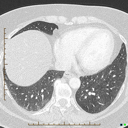 File:Bronchial diverticula (Radiopaedia 79512-92676 Axial lung window 152).jpg