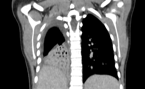 Bronchial mucoepidermoid carcinoma (Radiopaedia 57023-63895 Coronal 102).jpg