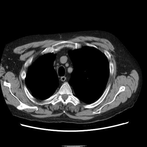 Bronchial stenosis - lung transplant (Radiopaedia 73133-83848 Axial non-contrast 15).jpg