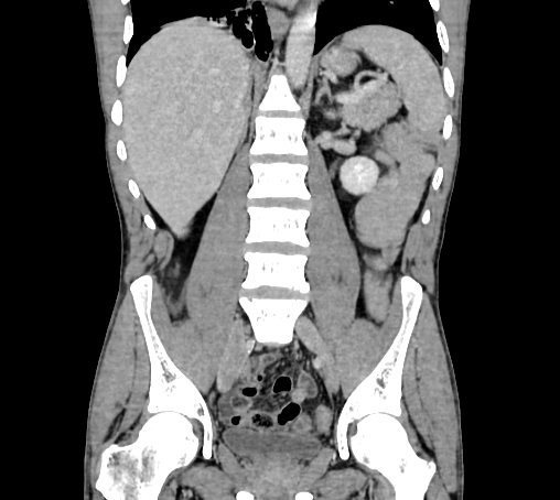 Bronchiectasis in Crohn disease (Radiopaedia 60311-67977 C 48).jpg