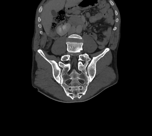 Bronchiectasis in Crohn disease (Radiopaedia 60311-67977 Coronal bone window 39).jpg