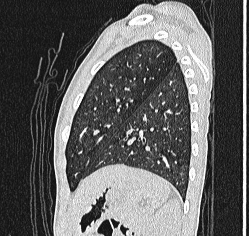 File:Bronchiolitis obliterans (Radiopaedia 71538-81897 Sagittal lung window 55).jpg