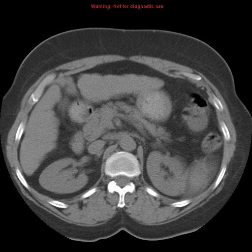 Bronchoalveolar carcinoma (Radiopaedia 13224-13233 Axial non-contrast 54).jpg