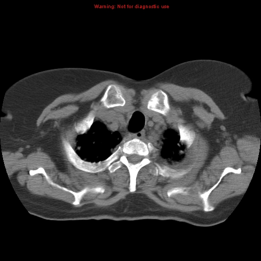 Bronchoalveolar carcinoma (Radiopaedia 13224-13233 Axial non-contrast 7).jpg
