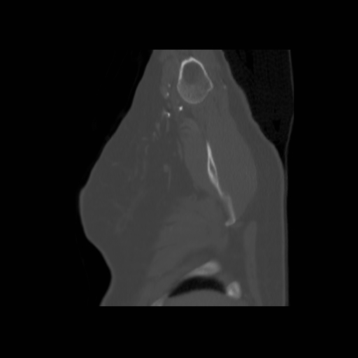 Bronchogenic carcinoma (Radiopaedia 73497-84262 Sagittal bone window 21).jpg