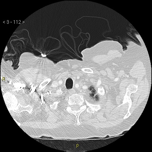 Bronchogenic carcinoma as an incidental finding (Radiopaedia 16453-16130 Axial lung window 112).jpg