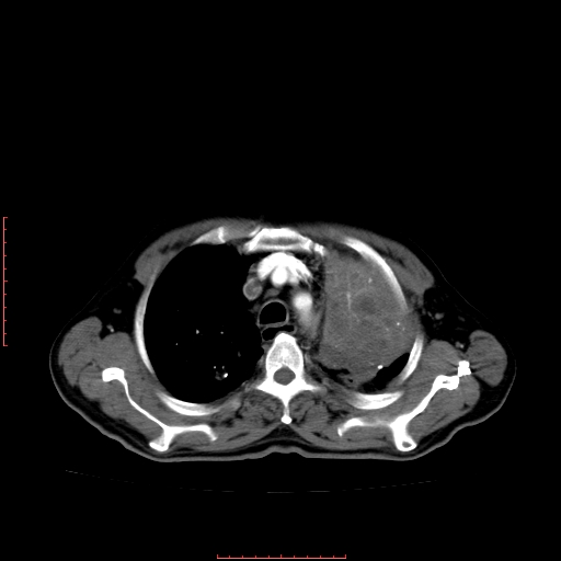 File:Bronchogenic carcinoma with left atrial large deposit - T4N3M1a (Radiopaedia 42316-45428 A 9).jpg