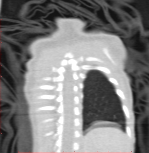 File:Bronchogenic cyst (Radiopaedia 78599-91409 Coronal lung window 197).jpg