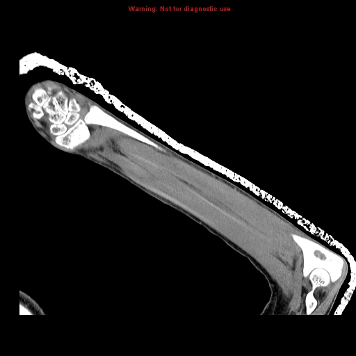 File:Brown tumor (Radiopaedia 12460-12694 A 16).jpg