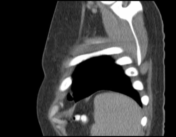Brown tumors compressing the spinal cord (Radiopaedia 68442-77988 B 51).jpg