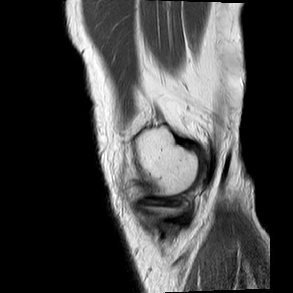 File:Bucket handle tear - medial meniscus (Radiopaedia 29250-29664 Sagittal PD 20).jpg