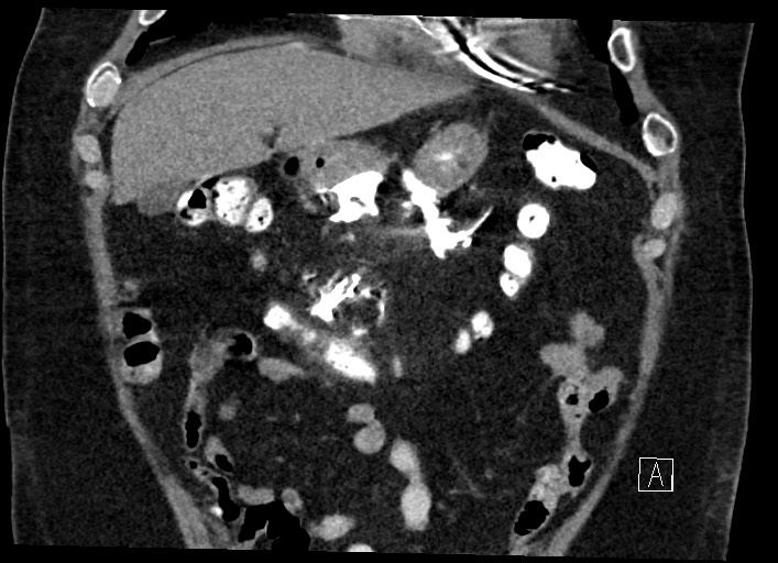 Buried bumper syndrome - gastrostomy tube (Radiopaedia 63843-72577 Coronal Inject 40).jpg