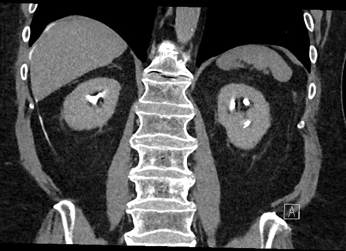Buried bumper syndrome - gastrostomy tube (Radiopaedia 63843-72577 Coronal Inject 94).jpg