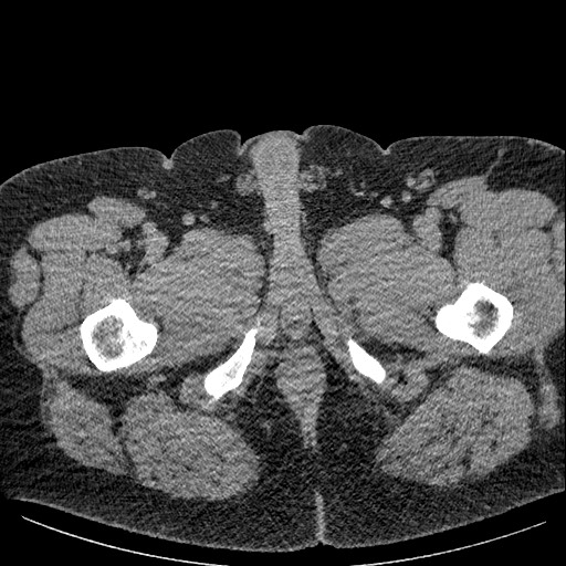 Burned-out testicular seminoma - retroperitoneal nodal metastases (Radiopaedia 62872-71245 A 78).jpg