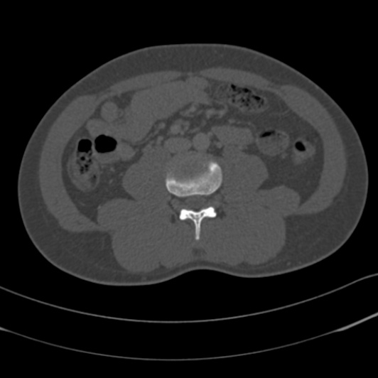 Burst fracture with cauda equina syndrome (Radiopaedia 25701-25867 Axial bone window 105).jpg