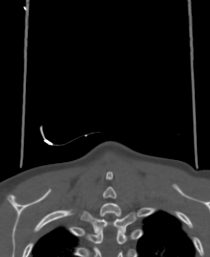 Butterfly vertebra (Radiopaedia 77903-90209 Coronal bone window 109).jpg