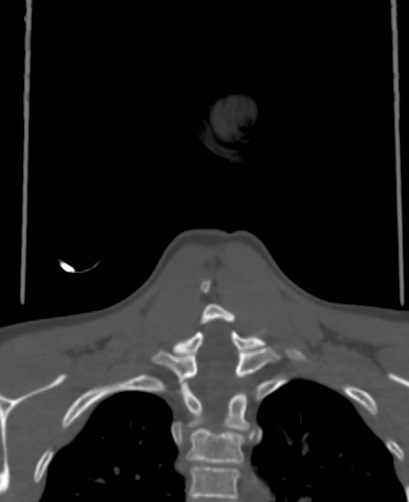 Butterfly vertebra (Radiopaedia 77903-90209 Coronal bone window 75).jpg