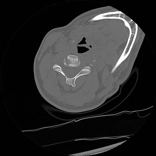 C1-C2 "subluxation" - normal cervical anatomy at maximum head rotation (Radiopaedia 42483-45607 Axial non-contrast 12).jpg