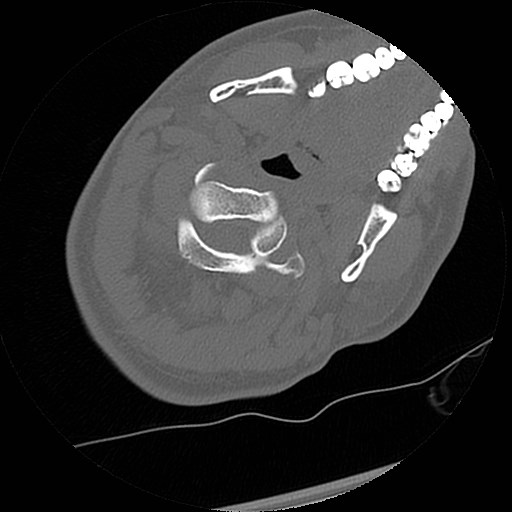 C1-C2 "subluxation" - normal cervical anatomy at maximum head rotation (Radiopaedia 42483-45607 Axial non-contrast 46).jpg