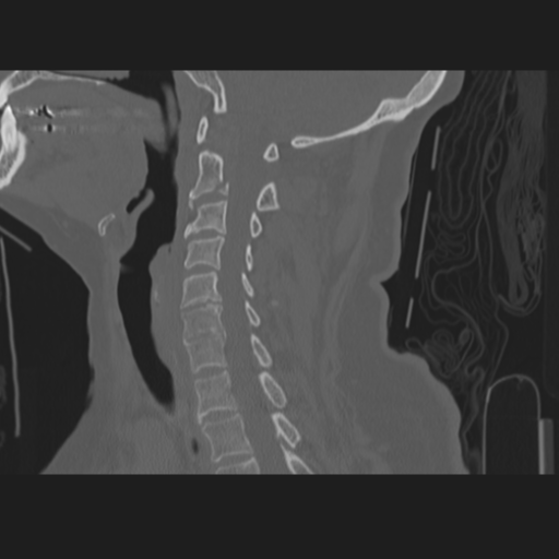 C2 fracture (Radiopaedia 34091-35341 Sagittal bone window 34).png