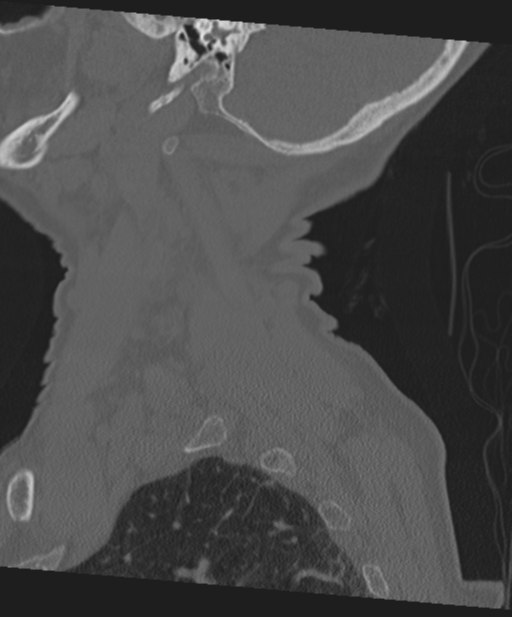 C2 fracture with vertebral artery dissection (Radiopaedia 37378-39199 Sagittal bone window 67).png