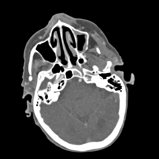 File:C2 fracture with vertebral artery dissection (Radiopaedia 37378-39200 A 213).png