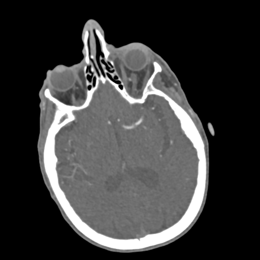 C2 fracture with vertebral artery dissection (Radiopaedia 37378-39200 A 245).png