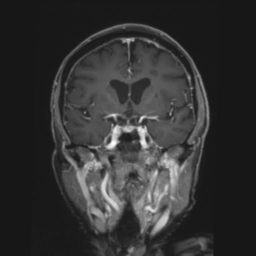 CNS lymphoma with steroid response (Radiopaedia 37980-39921 Coronal T1 C+ 18).png