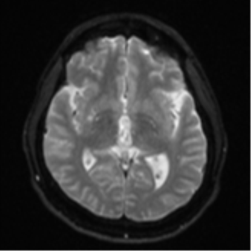File:CNS vasculitis (Radiopaedia 55715-62263 Axial DWI 14).png