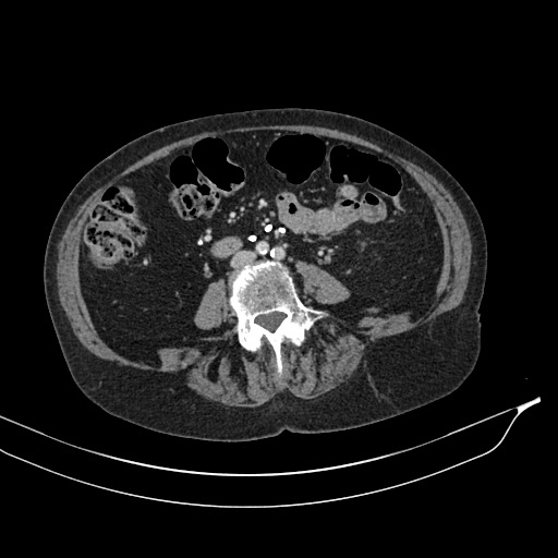 Calcified adrenal glands and Spigelian hernia (Radiopaedia 49741-54988 A 127).jpg