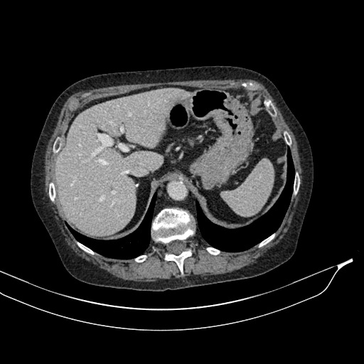 Calcified adrenal glands and Spigelian hernia (Radiopaedia 49741-54988 A 46).jpg