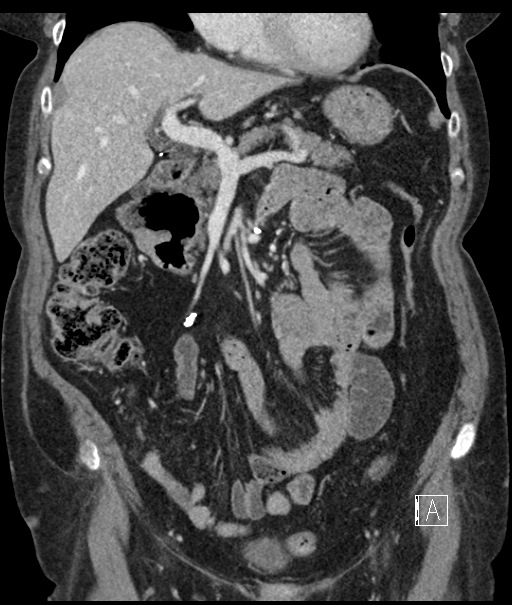 Calcified adrenal glands and Spigelian hernia (Radiopaedia 49741-54988 B 43).jpg