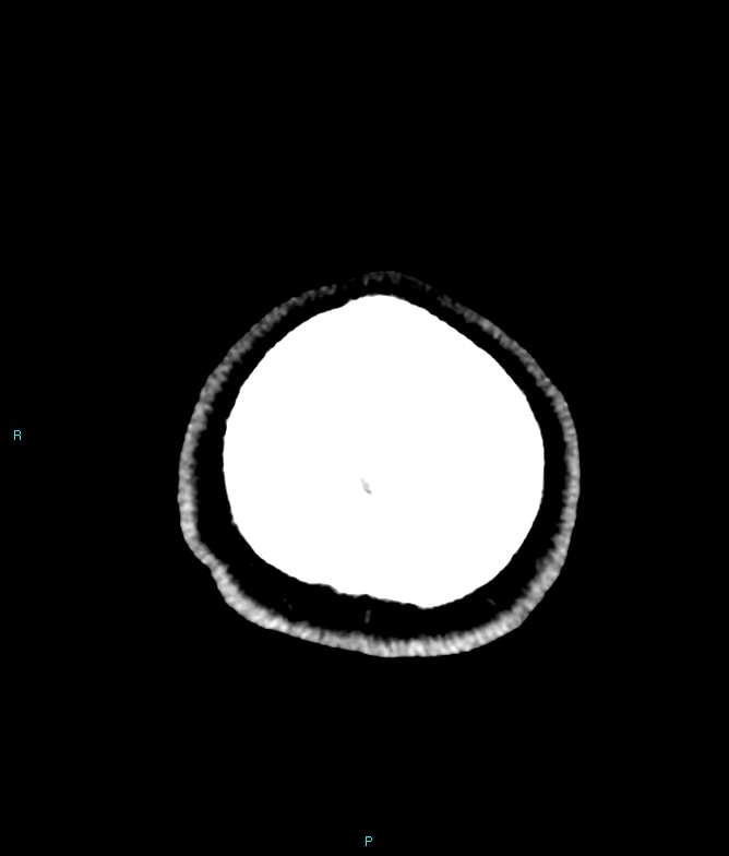 Calcified cerebral emboli from left ventricular thrombus (Radiopaedia 84420-99758 Axial non-contrast 5).jpg
