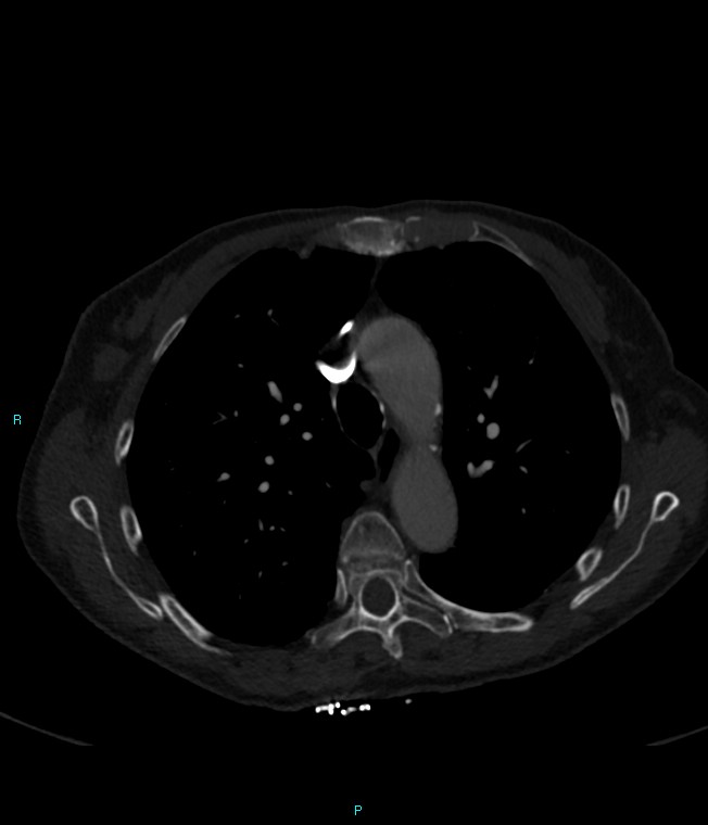 Calcified cerebral emboli from left ventricular thrombus (Radiopaedia 84420-99760 Axial bone window 26).jpg