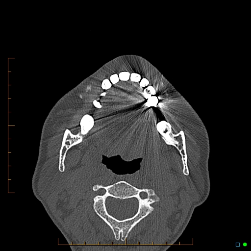 Calcified facial augmentation fillers (Radiopaedia 79514-92679 Axial bone window 108).jpg