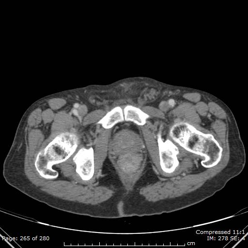 Calcified liver metastases (Radiopaedia 44699-48470 B 65).jpg