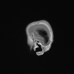 Callosal dysgenesis with interhemispheric cyst (Radiopaedia 53355-59335 Sagittal T1 11).jpg