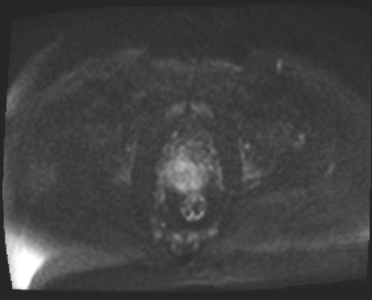 Cancer cervix - stage IIb (Radiopaedia 75411-86615 Axial DWI 65).jpg