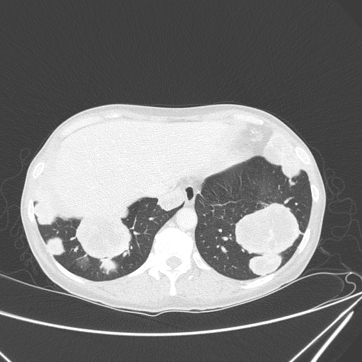 Canonball lung metastasis (Radiopaedia 77634-89837 Axial lung window 149).jpg