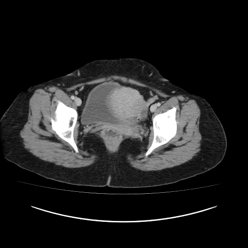 Carcinoma colon - hepatic flexure (Radiopaedia 19461-19493 A 119).jpg
