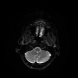 Carcinoma ex-pleomorphic adenoma of parotid (Radiopaedia 28383-28627 Ax DWI B-500 GE 22).jpg