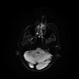 Carcinoma ex-pleomorphic adenoma of parotid (Radiopaedia 28383-28627 Ax DWI B-500 GE 62).jpg