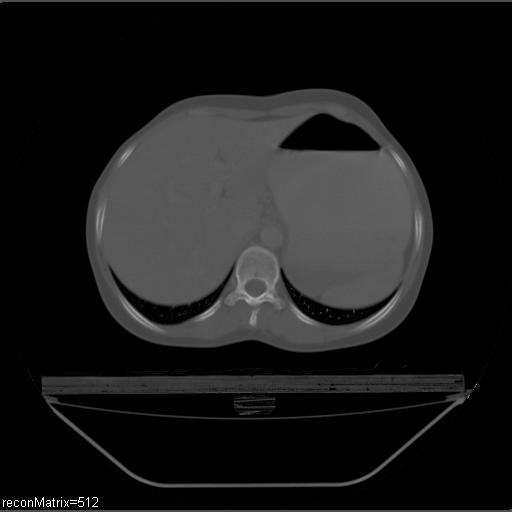 File:Carcinoma of esophagus (Radiopaedia 27356-27550 Axial bone window 5).jpg