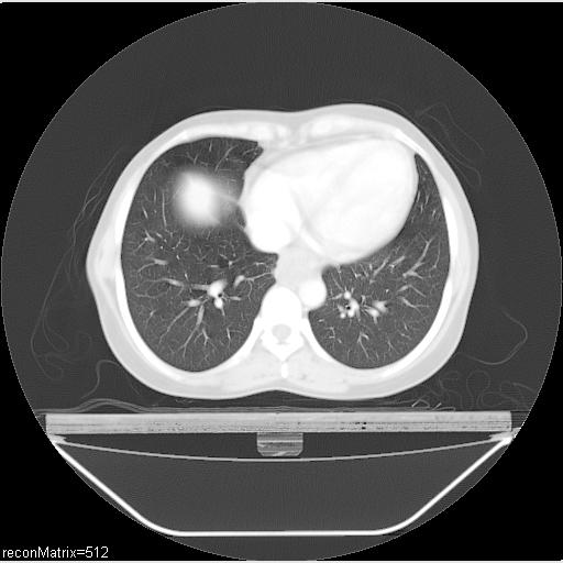 File:Carcinoma of esophagus (Radiopaedia 27356-27550 Axial lung window 12).jpg